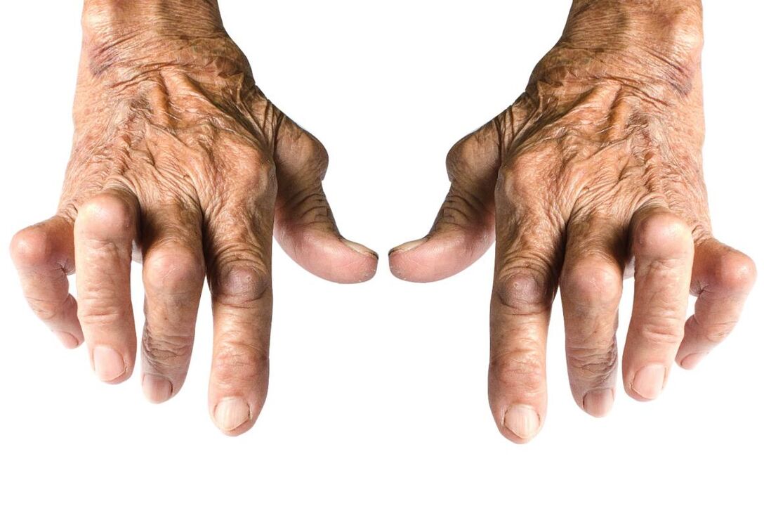 znakovi artritisa – deformacija zgloba