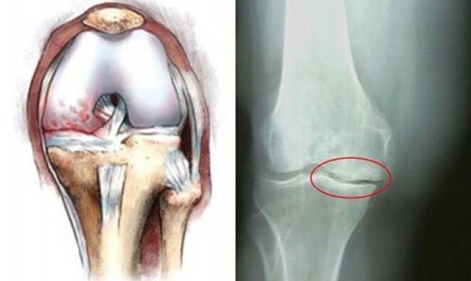 artroza koljena rentgen