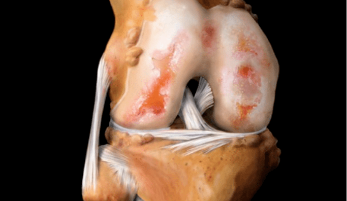 osteoartritis zgloba koljena