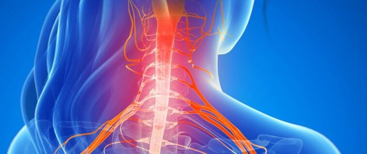 Kompresija žila leđne moždine kod osteohondroze vratne kralježnice