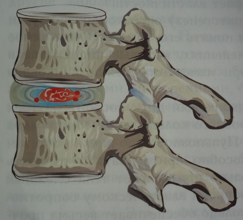 Oštećenje nucleus pulposus intervertebralnog diska u prvoj fazi cervikalne osteohondroze
