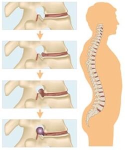 Četiri faze razvoja cervikalne osteohondroze