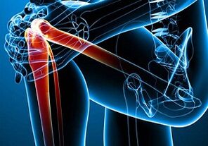 bol u koljenu s artritisom i artrozom