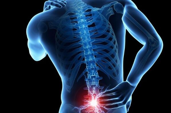 Akutna bol u donjem dijelu leđa je simptom pomaka intervertebralnih diskova