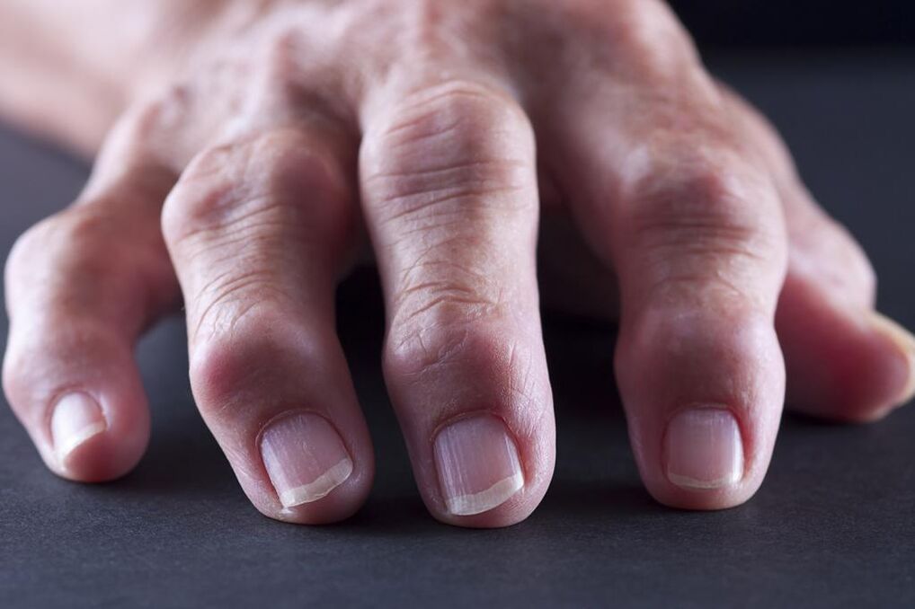 Burzitis karakterizira bol, upala i oticanje zglobova prstiju