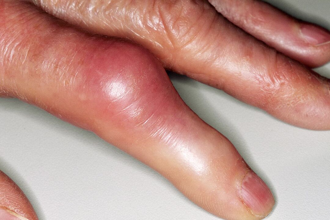 Otok, deformacija zgloba prsta i akutna bol nakon ozljede