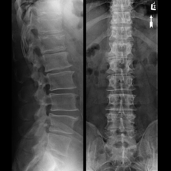 Sning od kralježnice s osteohondrozom
